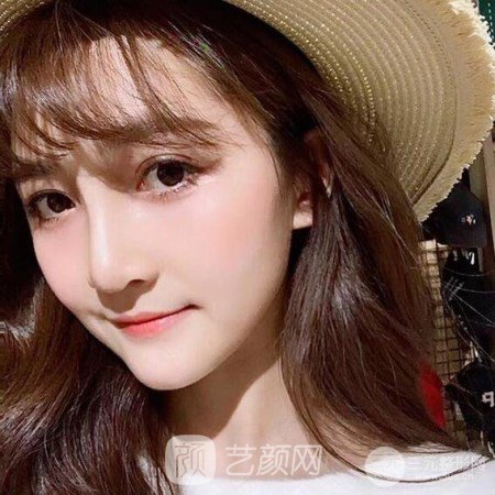 武漢華亞李愛(ài)林自體脂肪面部填充三個(gè)月案例分享~